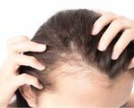 قطع مصرف ماینوکسیدیل ریزش موها را بدتر می‌کند؟